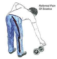 Sciatica Shakopee MN