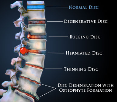 disc bulge shakopee mn